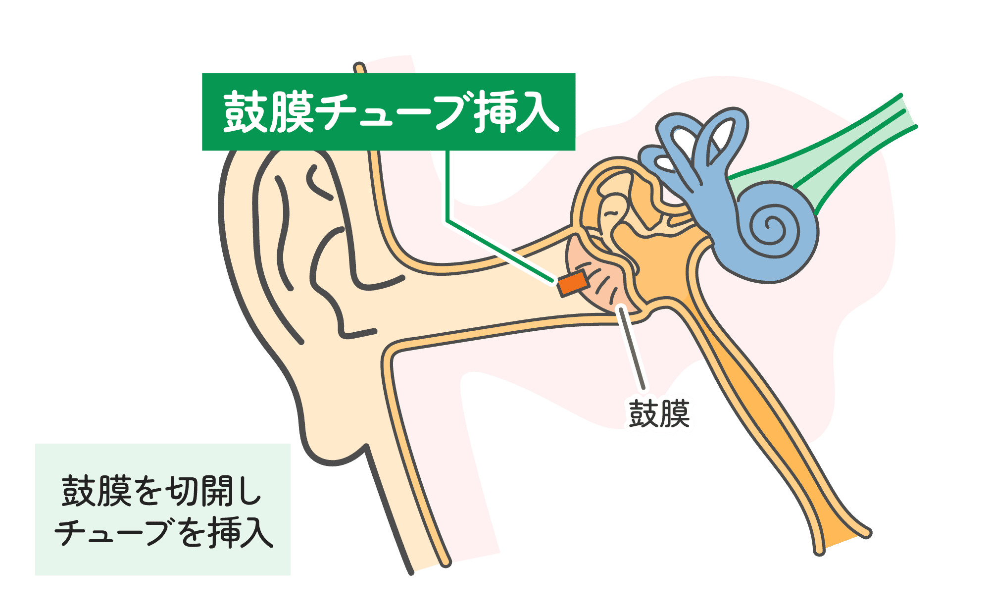 鼓膜チューブ挿入術